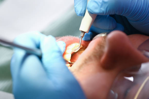 Best Chipped Tooth Repair Near Me  in Montgomeryville, PA